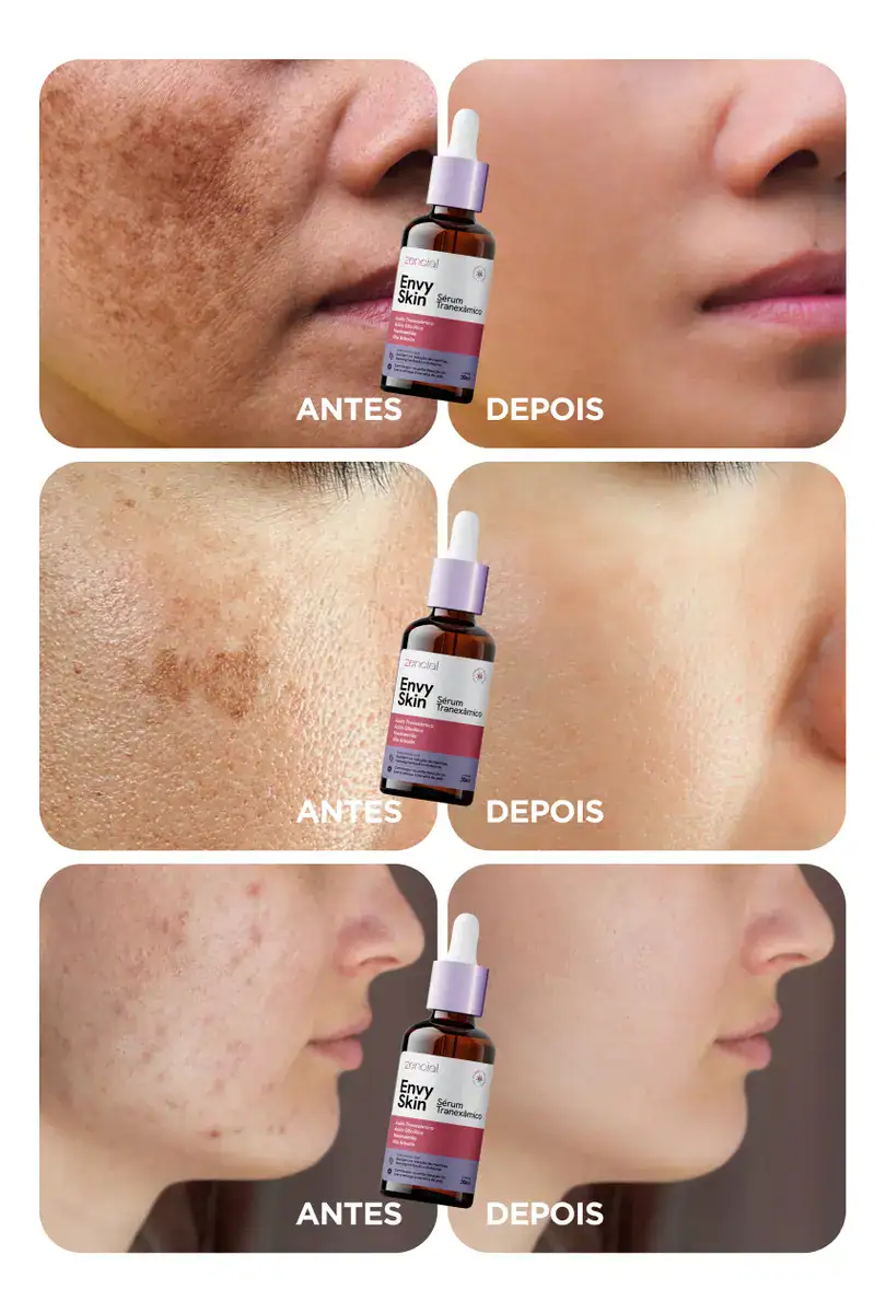 Sérum Zencial Envy Skin Ácido Tranexâmico Clareador Manchas e Melasma Profundo 30 mL - Imagem 3