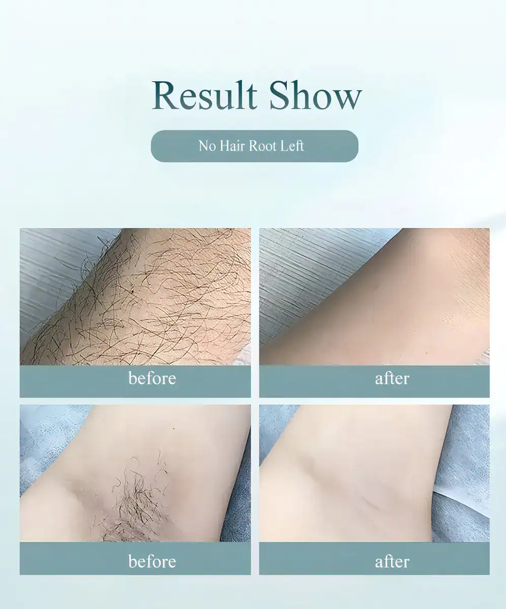 Depilador A Laser Luz Pulsada IPL Basike Sensacao Gelo Indolor Depilacao Definitiva 1 Milhao Disparos 9 Niveis Rosto Corpo aparelho depilacao feminino depilação a laser laser depilacao depilacao intim - Imagem 3